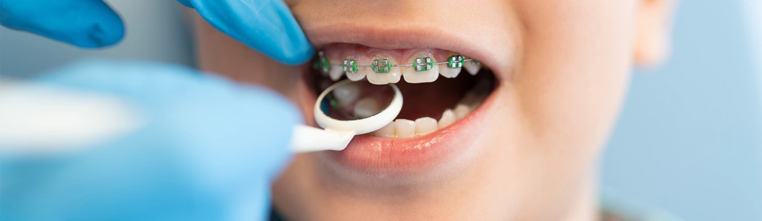 Custom-Made Braces in Flushing NY