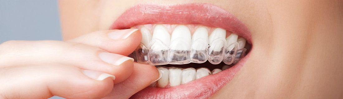 Clear Aligners in Flushing NY: The Modern Way to a Perfect Smile