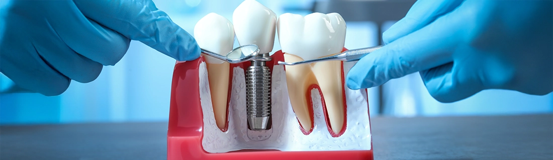 Dental Implants in Flushing NY