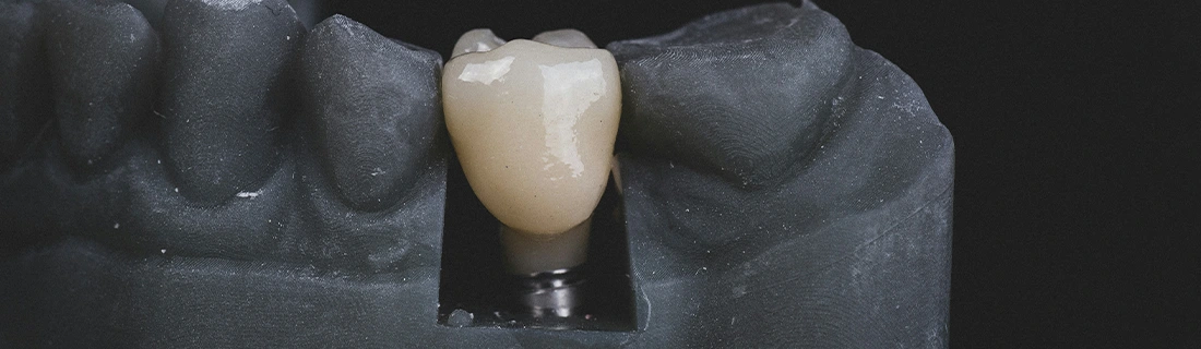 FC – Restoring Oral Health with Precision: Sunshine Dental Implants