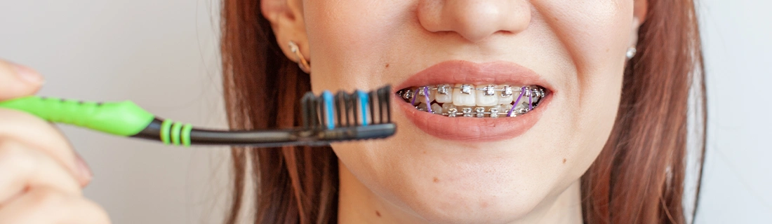 Braces Tips And Tricks in Flushing NY