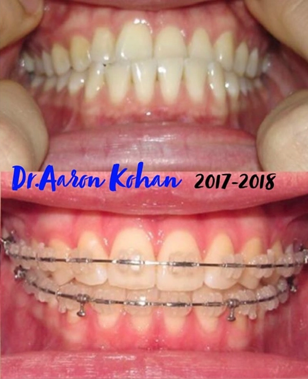 Teeth Before And After Braces At Sunshine Dental