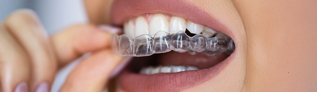 Adult Invisalign Dentist in Flushing NY