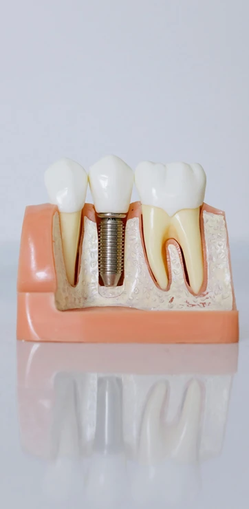 Dentist Flushing NY Model of Dental Implants For Patients Understanding Model of Dental Implants For Patients Understanding